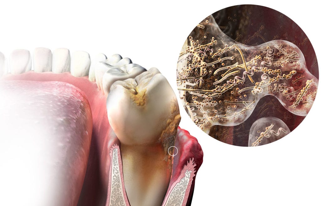 Plaque Formation on Teeth