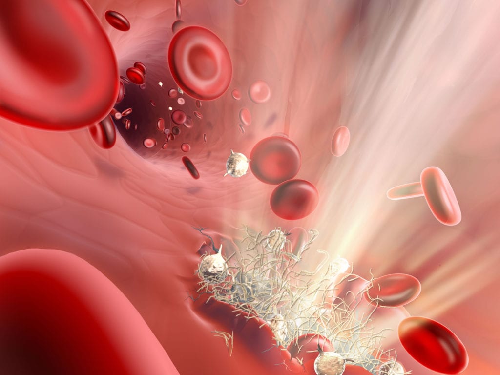 Medical art of a blood clot with platelets and red blood cells, by Nicolle R. Fuller
